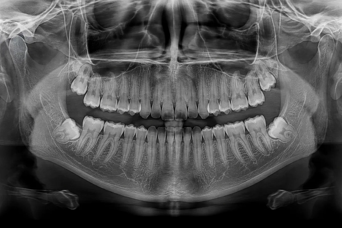 Panoramic X-Rays